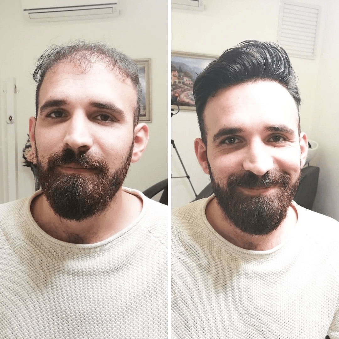 Upgrade Mirage |0.04-0.06mm Full Super Thin Skin Single Knots Base | Toupee for Men | Celebrities Choice